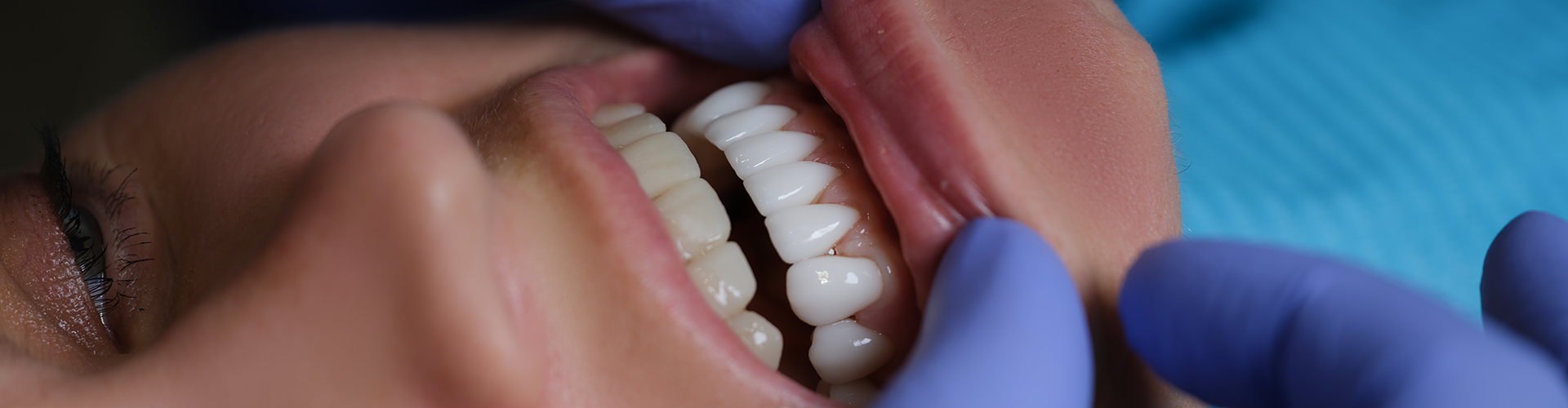 gloved hands pushing down woman's lower lip to show teeth.